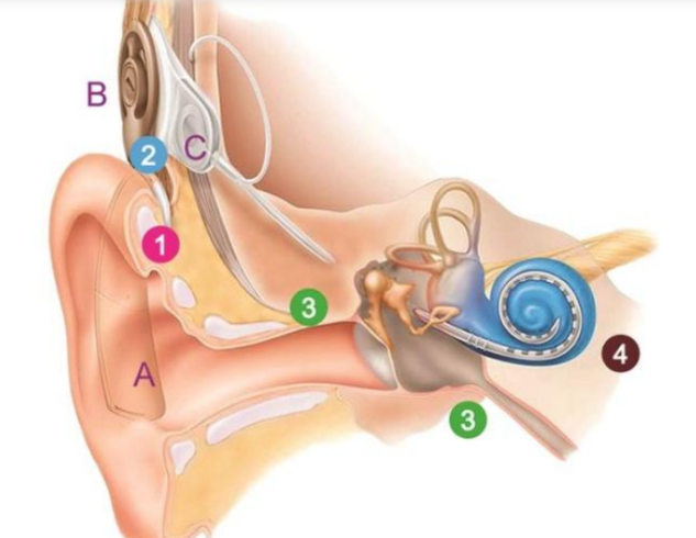 人工耳蝸.png 人工耳蝸.png